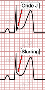Onde J et Slurring, Électrocardiogramme de repolarisation précoce